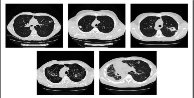 Figure 3 - Exemples de types de TB. Première rangée, de gauche à droite: Infiltrative, Focale, et  Tuberculome