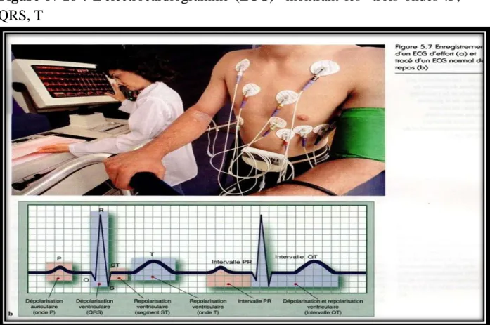 Figure  N°16  :  L'électrocardiogramme  (ECG)    montrant  les    trois  ondes  :P,  QRS, T  
