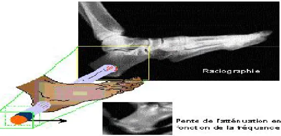 Figure 1.8 Mesure de qualité osseuse par ultrasons [LAUG02] 