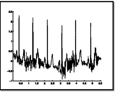 Figure 1.15 : Bruit myoéletrique ou tremblement somatique. 