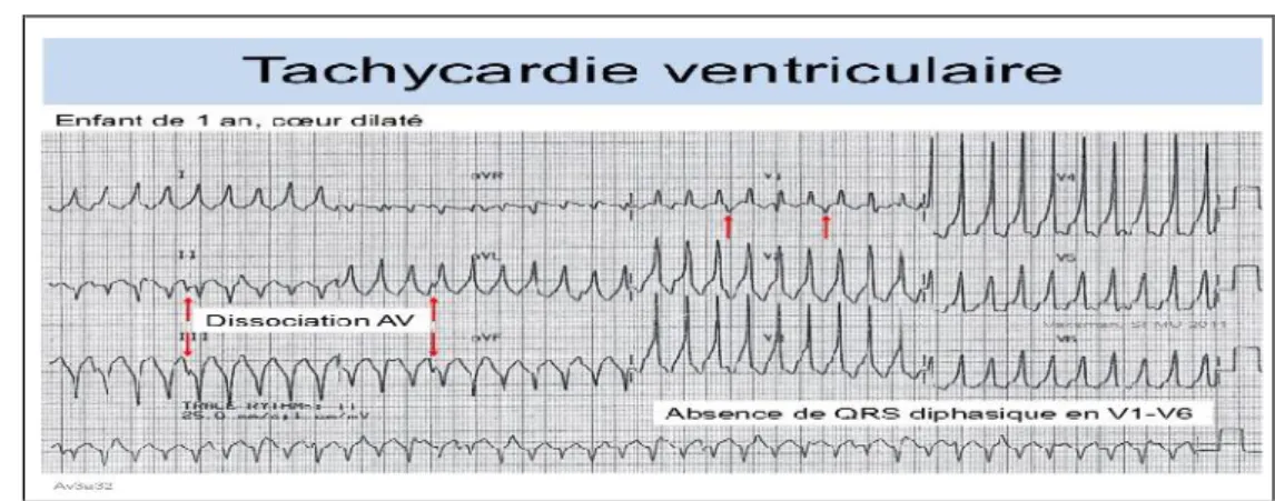 Figure 1.6: Exemple de tachycardie ventriculaire. [Briand, 2001]
