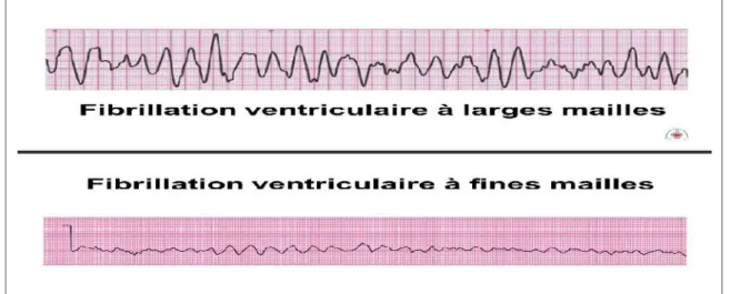 Figure 1.7: Exemple d'accès de fibrillation ventriculaire. [Talbi,2011]