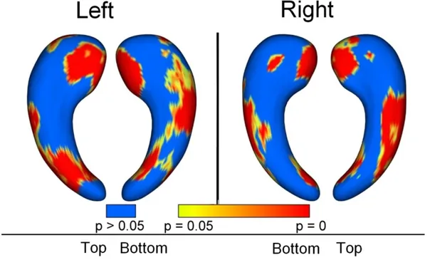 Figure 6 . Group differences between AD and controls. Regions with statistically significant  atrophy (p&lt;0.05) are displayed in colors ranging from yellow to red, blue areas correspond to  regions with no significant differences