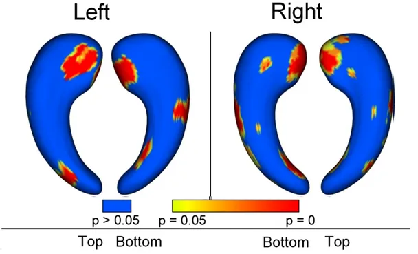 Figure 7.  Group differences between MCI and controls. Regions with statistically significant  atrophy (p&lt;0.05) are displayed in colors ranging from yellow to red, blue areas correspond to  regions with no significant differences