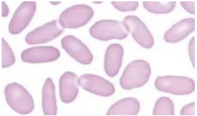 Fig 07 : Elliptocyte ou ovalocyte ( Hoffman et al ., 2012 ) 