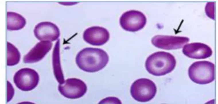 Fig 09 : Microsphérocyte ( Hoffman et al ., 2012 ) 