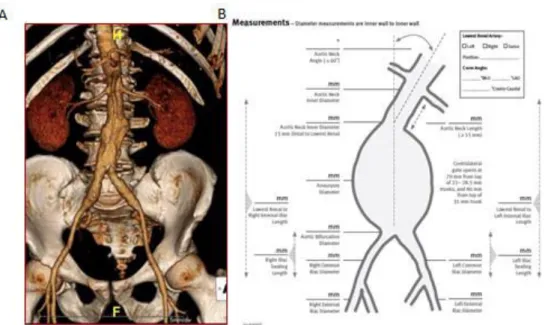 Figure 1 : (A) Reconstruction  à l’angioscanner  en 3 dimensions  d’un AAA . (B) Planche de 