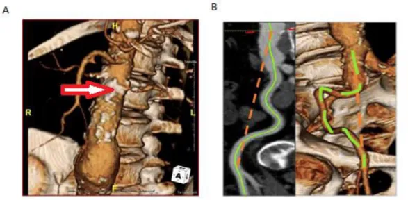 Figure 3 :  Image représentative d’un thrombus au scanner  (flèche) sur une aorte en coupe  sagittal (A) et axiale (B)