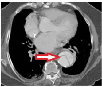 Figure 5: Angioscanner en coupe axiale montrant  une dissection aortique au scanner avec un  aspect en balle de tennis de l’aorte (flèche rouge) 