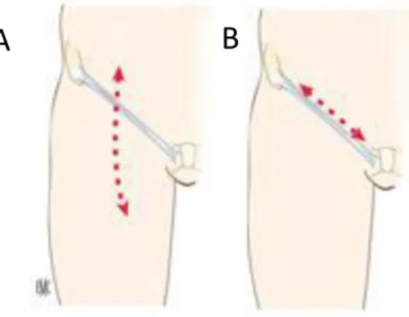 Figure 10  : Voie d’abord chirurgicale  par (A) incision verticale ou (B) parallèle au pli  inguinal