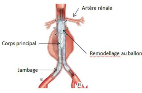 Figure 11 :  Mise en place d’une endoprothèse bifurquée . 
