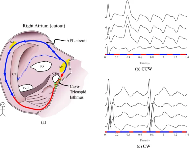 Figure 2.15: Mechanism of typical AFL. (a) Typical CCW AFL circuit, turning around specific anatomic landmarks; (b) and (c) Resulting ECG in leads II, III, aV F and V 1