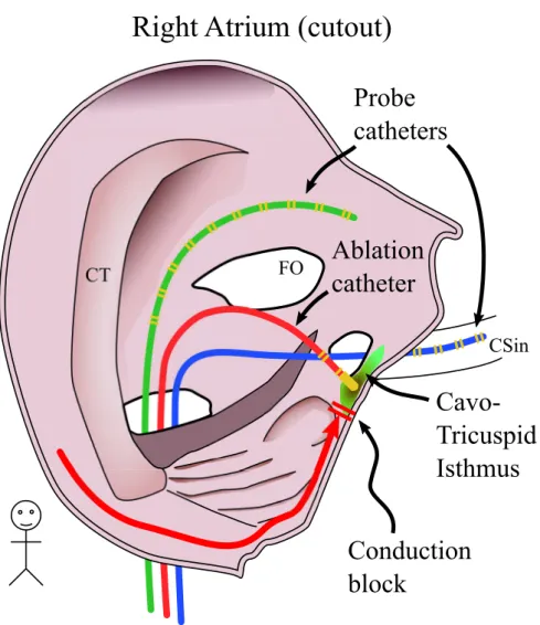 Figure 2.17: Cardiac ablation procedure using duodecapolar probe catheter for map- map-ping.