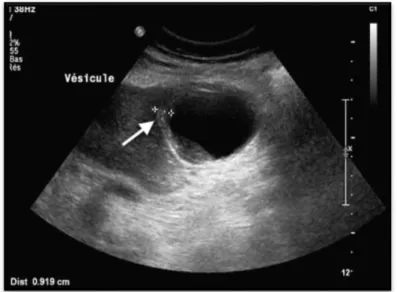 Figure 13 .Cholécystite aiguë à l'échographie. 