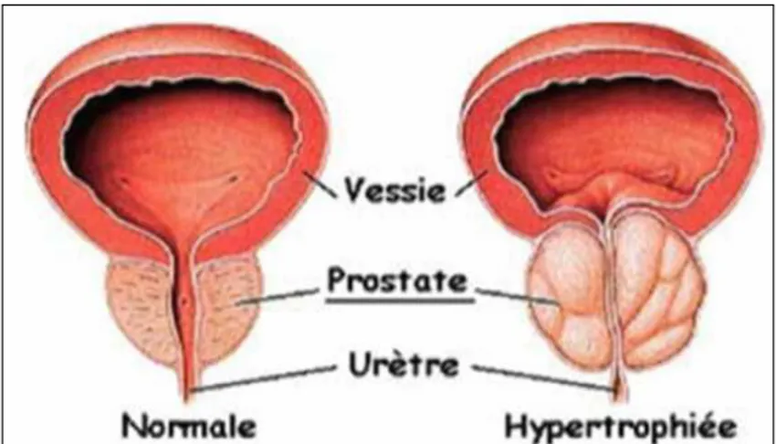 Figure 4 : Hypertrophie bénigne de la prostate  (Boulfhrad et Bouatrous, 2017). 