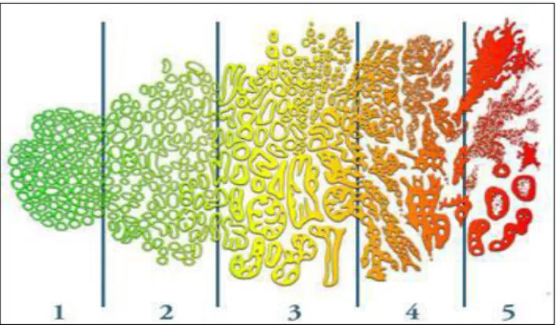 Figure 5 : Représentation des grades histologiques  du cancer de la prostate (Al Nakouzi, 2011)