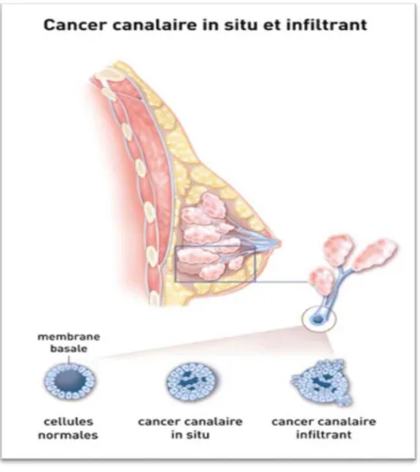 Figure 08 : cancer canalaire in situ et infiltrant. (Actualisation du référentiel de pratiques de 