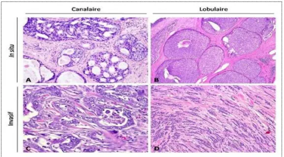 Figure 02 : Carcinome canalaire et lobulaire  (Campus d'Anatomie Pathologique ,2010)  A : carcinome canalaire in situ                    C : carcinome canalaire invasif   B : carcinome lobulaire in situ              D : Carcinome lobulaire invasif 