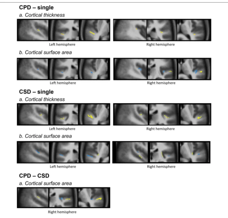 FIGURE 4 | Morphology and relationships between variations in CT and CSA. Projection of the SBM results on the volumetric means of each group of individuals defined according to their gyrification pattern