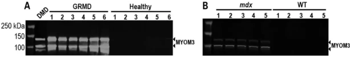 Figure 4. Upper panel: Western blot analysis of the MYOM3 fragments in serum from 3 LGMD2D patients (#1 is 35, #2 is 23 and #3 is 24 years old)
