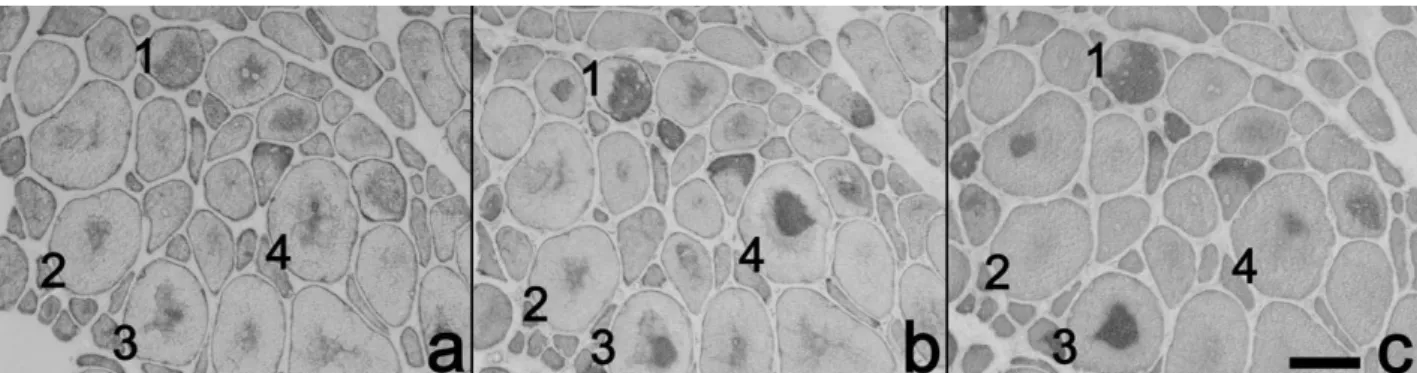 Figure 4. Ultrastructural findings in muscle fibres from patients. Electron microphotographs of myofibres from patient 4 (a), patient 6 (b), patient 5 (c, d, e) and patient 3 (f) show different ultrastructural alterations