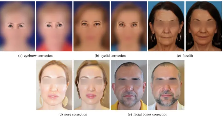 FIGURE 2: Examples of facial portrait images before (left) and after (right) different kinds of most popular facial plastic surgeries (web-collected images have been anonymized to protect the individuals’ privacy).