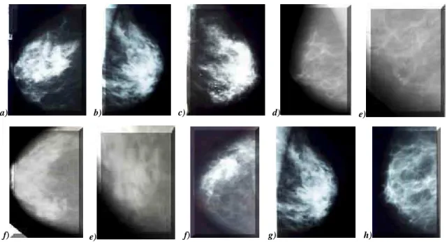 Fig. I.6 – Images de microcalcifications d'allure maligne 