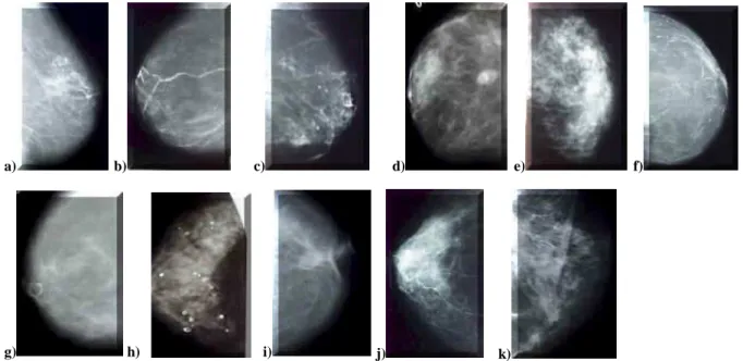 Fig. I.7 – Images de microcalcifications d'allure bénigne 