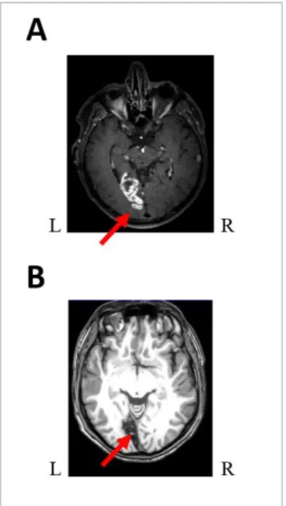 Figure 6: Neuroanatomical lesion analyses: (A)   P6, right  homonymous hemianopia  and blindsense, 3D Flair 8000  sequence  acquisition  showing  the  lesion  of  BA  17  and  18  in  the  left  hemisphere  and  (B)  P8,  right  homonymous  hemianopia with