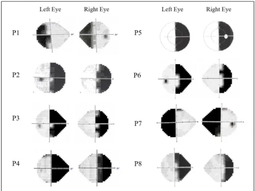 Figure 1: Automated visual perimetry, HH group (n = 8). The axial hash-marks denote  increments of 10º (visual) and the greyscale denotes sensitivity (in decibels)