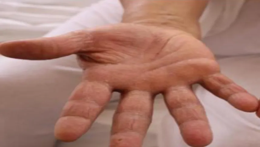 Figure 09. Candidose cutanée (les mains) (Lorier joy, 2005). 