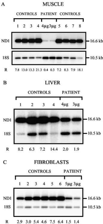 Fig. 2. Southern-blot analysis of mtDNA from muscle (A), liver (B) and cultured fibroblasts (C) of patient 10 with mtDNA depletion.