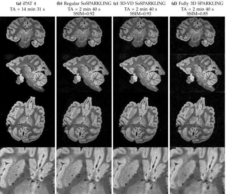 Fig. 5. 600 µm isotropic ex vivo results comparing different SPARKLING strategies. Column (a): iPAT 4 (GRAPPA) acquisition lasting TA = 14 min 31 s