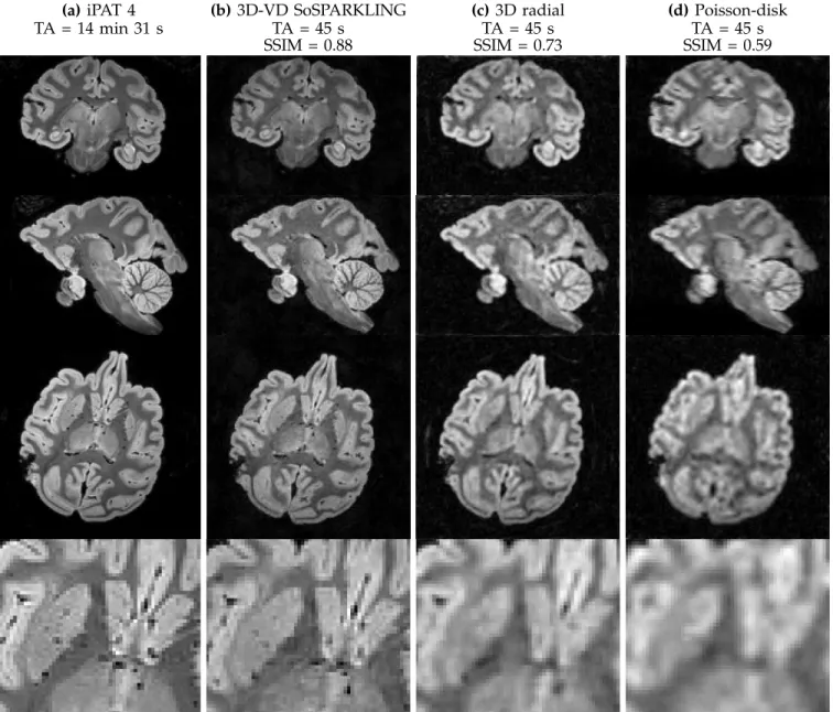 Fig. 6. Ex vivo results of 0.6 mm isotropic resolution comparing 3D-variable density stack-of-sparkling (3D-VD SoSPARKLING) (b), 3D radial (c) and 3D Poisson-disk lines (d) samplings for a total number of shots of 1140, i.e., an acquisition time of 45 s