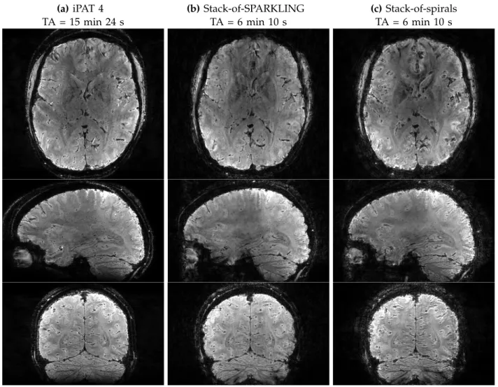 Fig. 7. In vivo results of 0.6 mm isotropic resolution comparing regular stack-of-SPARKLING (SoSPARKLING) (b) and a stack-of-spirals (c) samplings (with a 2D variable density in each plane) for a total of 9984 shots, i.e., an acquisition time of 6 min 10 s