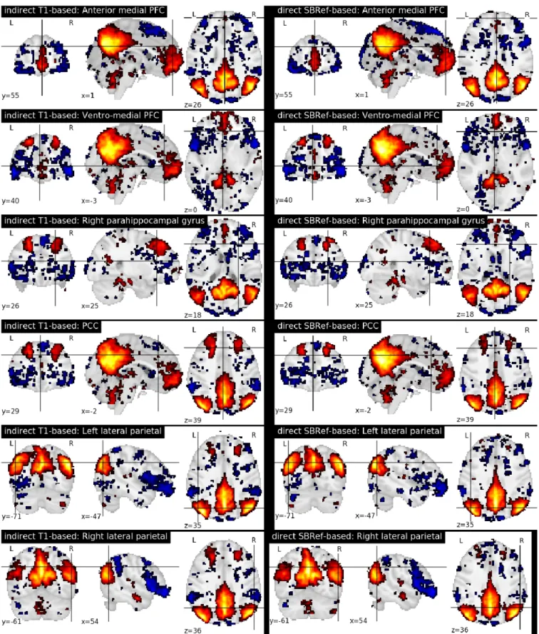 Figure 7. Comparing functional brain networks from subject fMRI images registered with both pipelines, namely the classical indirect T1-based method, and our proposed direct EPI-based method)