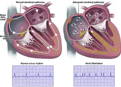 Figure 3.1: Heart electrical wavefront propagation during SR (left) and AF (right) and their effects on ECG pattern 3 .