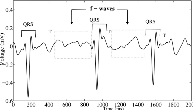 Figure 4.1: Example of ECG recording during AF and its characteristic waves. Boxes highlight TQ intervals where f-waves can be observed.