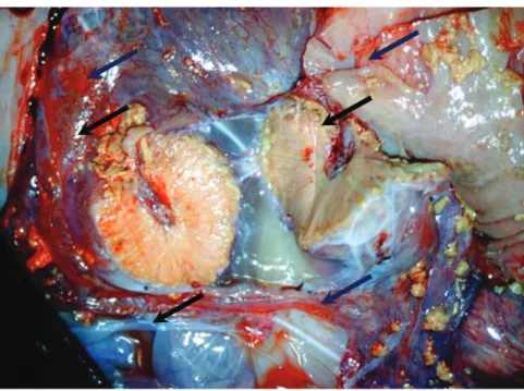 Figure 12. Placentite nécrosante: utérus en coupe, contenant un exsudat  nécrotique fibrineux multifocal à la surface caronculaire (flèche noire),  associé à une hémorragie multifocale (flèche bleue) (Neta et al., 2010).