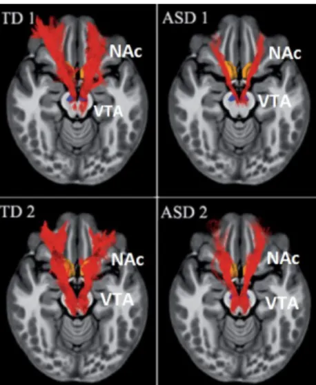 Figure 4: Mesolimbic reward pathway: white matter tracts connecting the NAc and the VTA  (Supekar et al., 2018)