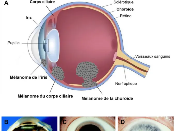 Figure 3 : Localisations anatomiques des mélanomes uvéaux 