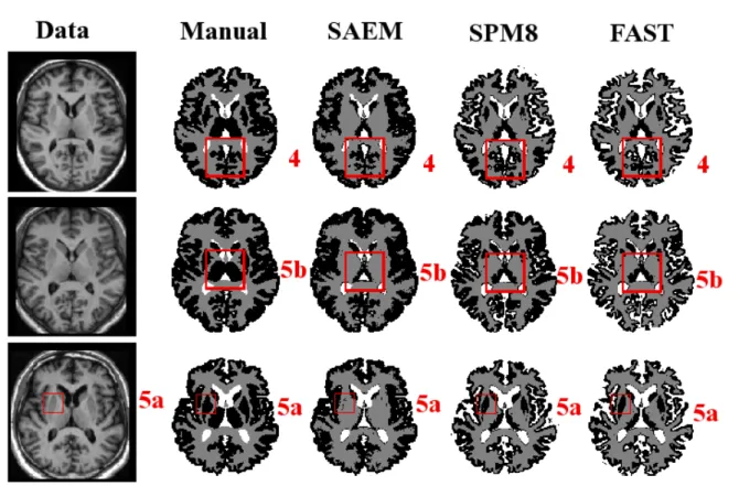 Figure 7. Experiments on real data. Each column corresponds to the one slice of 3 data images, the manual segmentation and the segmentation obtained by our method, SPM8 and FAST