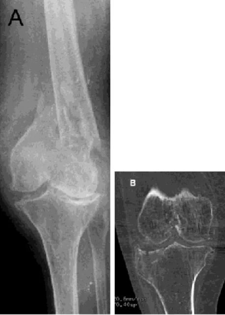 Fig. 1. A. The patient presents in emergency with complex comminuted joint frac-  ture of the distal femur