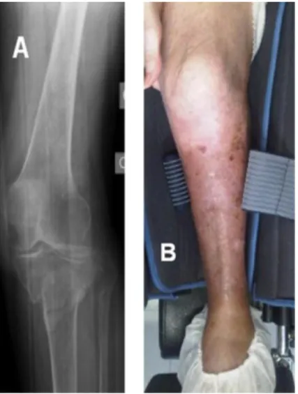 Fig.  5.  Complete  destruction  of  the  distal  femur  in  road  accidents  in  younger  patients is rarer (A), but may in some cases be a good indication for ﬁrst-line arthro-  plasty (B)
