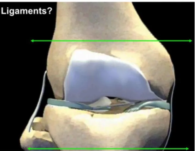 Fig. 7. Schematically, when the fracture involves the tibial or femoral collateral  ligament insertions, a rotating-hinge implant should be used