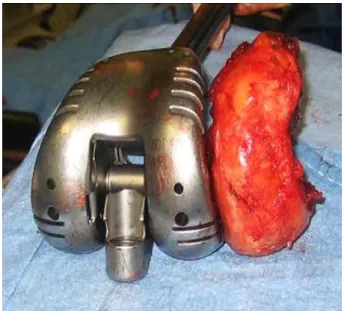 Fig. 11.  In complex femoral fracture, the classical femoral component measurement  instruments may be unusable, due to joint comminution