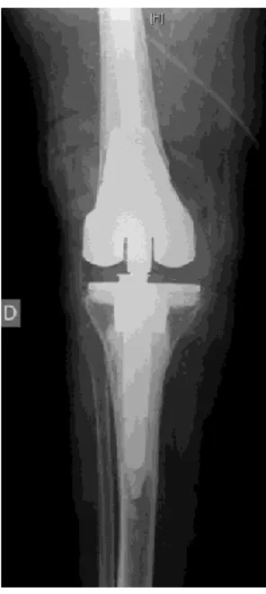 Fig. 14.  The principles are those of prosthetic revision [18]. We recommend apply-  ing the principles described by Morgan-Jones et al., [18], with 3 zones of ﬁxation: 