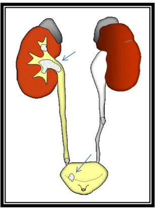 Figure 14 : Dilatation d’amont calculs ayant migré dans l’uretère Calcul formé dans les  cavités rénales calcul formé ou  ayant   migré dans la vessie [35]