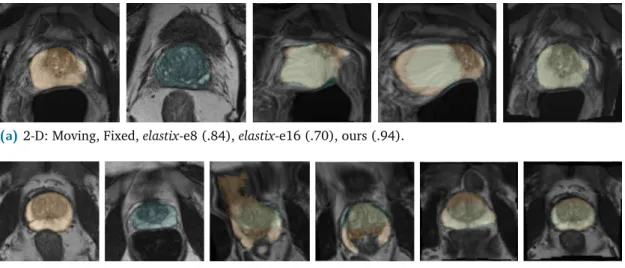Fig. 3.2: 2-D and 3-D registration results of extreme cases with segmentation masks overlays (fixed: green, moving: orange) and DICE scores in parenthesis.