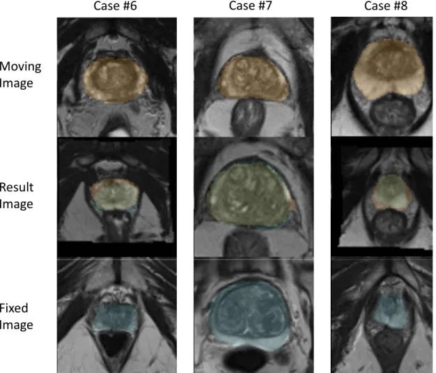 Fig. 3.4: 3-D registration results with final DICE scores for the 3 cases of .83, .85, .83 with initial overlaps of .57, .54, .54.